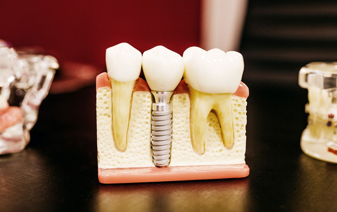 Foto de implantes