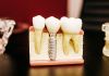 Foto de implantes