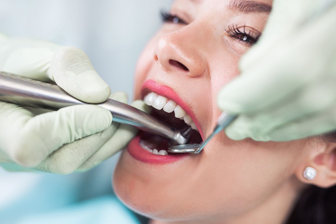Foto de endodoncia